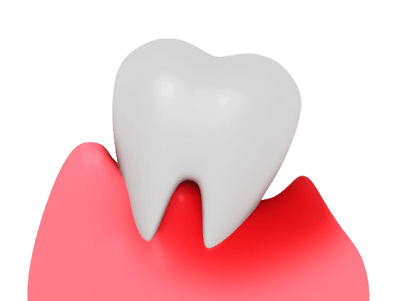 歯を失う最大の原因　歯周病とは？