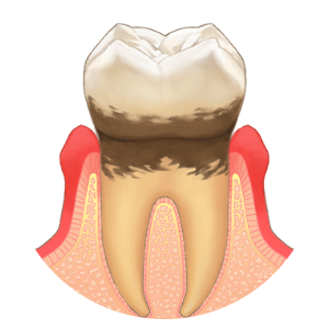 軽度歯周炎