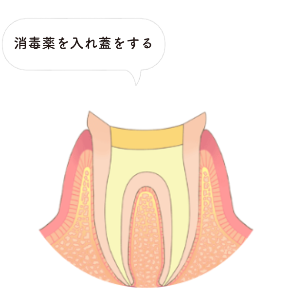 根管の清掃と消毒