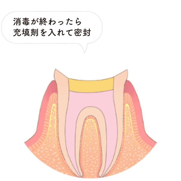 根管充填と被せ物の装着