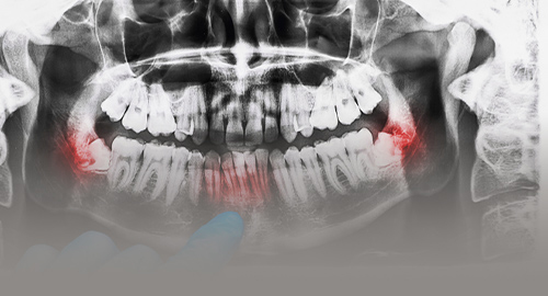 歯根の先を切除する治療