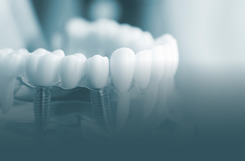 失った歯を人工歯で回復する治療