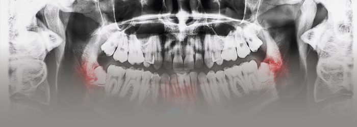 歯根の先を切除する治療