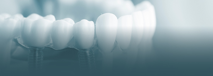 失った歯を人工歯で回復する治療